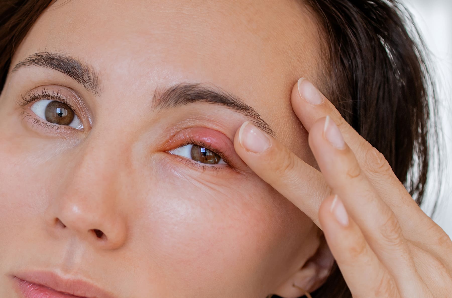 Optometrist Explains How to Get Rid of a Stye